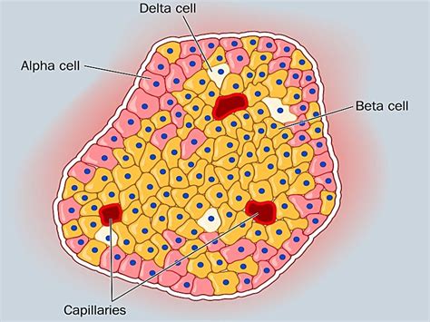 Islet-Cell Transplants May Benefit Type 1 Diabetes Patients