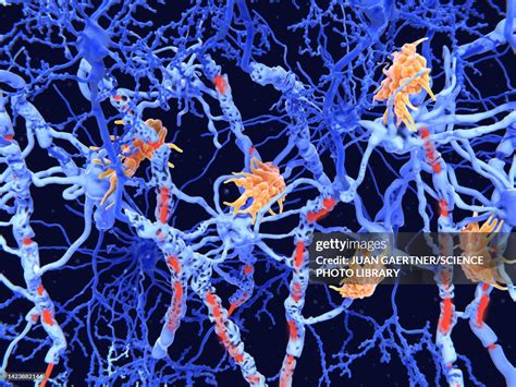 Nerve Damage In Multiple Sclerosis Illustration High-Res Vector Graphic - Getty Images