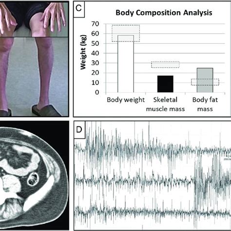 Clinical features and diagnosis of a patient with myotonic dystrophy... | Download Scientific ...