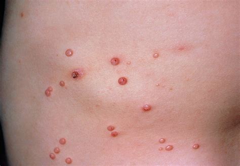 Molluscum contagiosum