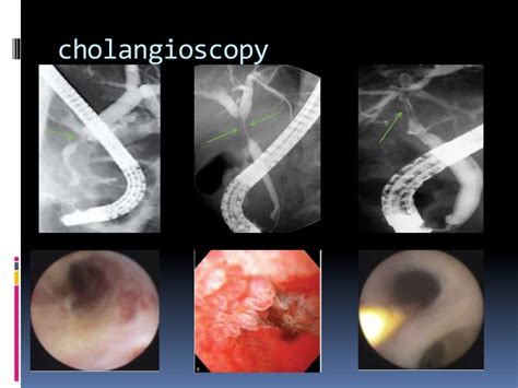 Biliary stricture ppt