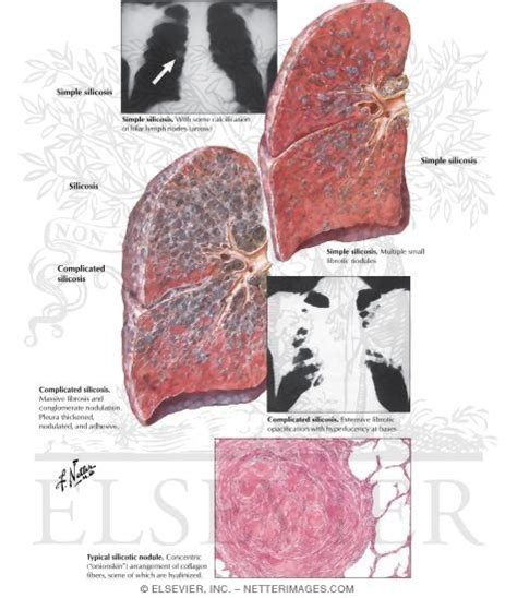 Silicosis