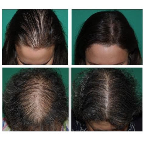 Details 73+ androgenic alopecia hairstyles best - in.eteachers