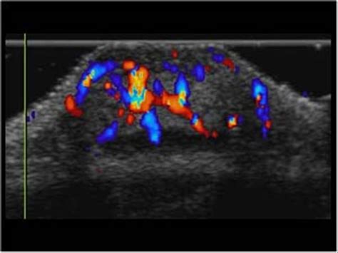 Pediatrics | 9.5 Pediatric head and neck : Case 9.5.1 Cysts and masses | Ultrasound Cases