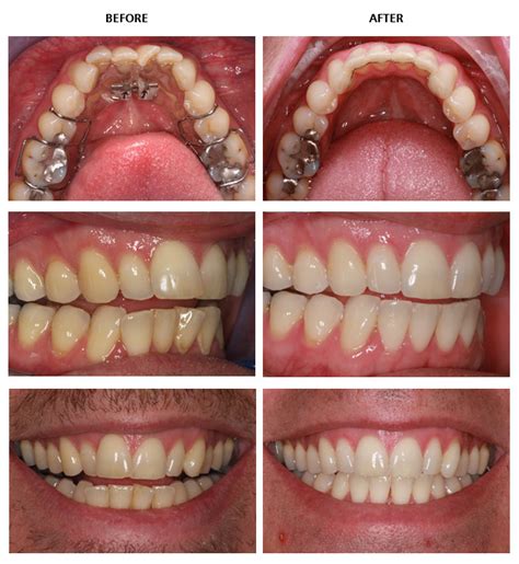 Inman Aligner before and after pictures - Inman Aligner