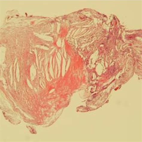 Histology slide shows clefts of cholesterol crystals and pools of blood... | Download Scientific ...