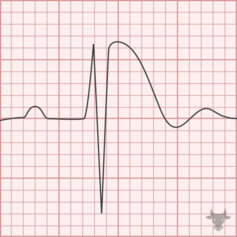 Brugada Syndrome | ECG Stampede