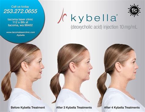 Kybella | Laser clinics, Kybella, Laser