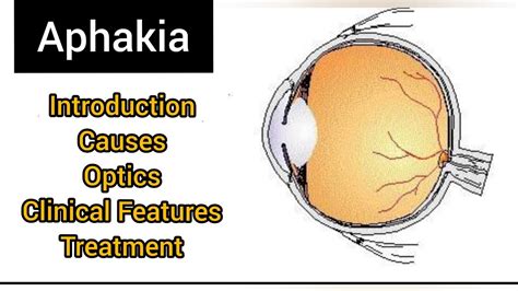 Aphakia |AK khurana 6th edition |Opto-cruisers #optometry #optometrists #aphakia #eye #youtube ...