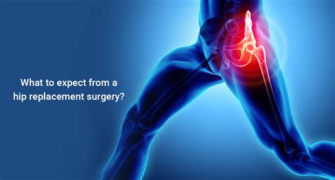 What to expect from a hip replacement surgery : Eternal Hospital