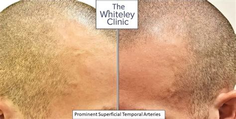 Superficial temporal arteries (temple arteries)