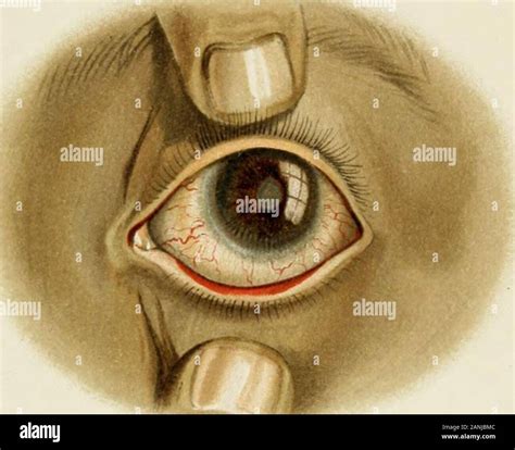 Eye injuries and their treatment Stock Photo - Alamy