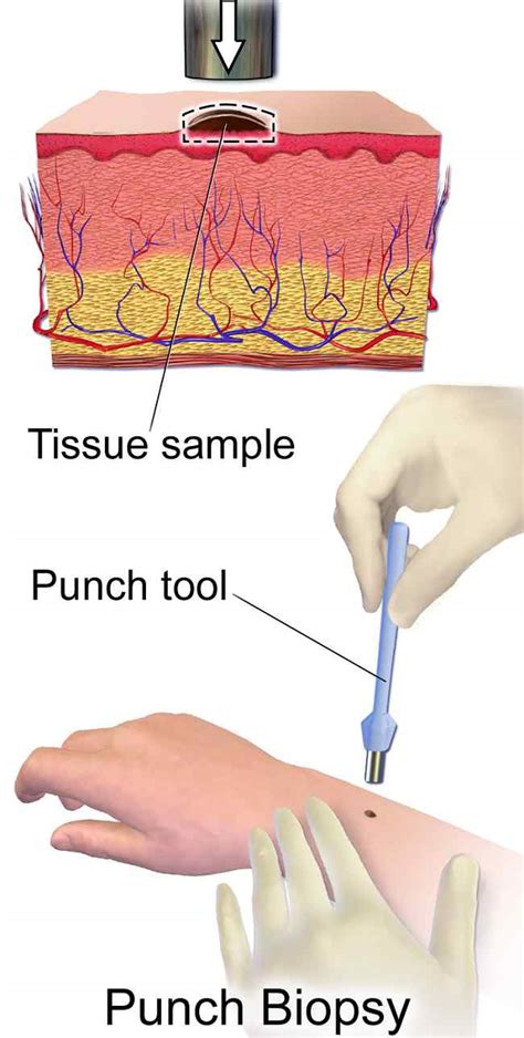 Biopsi Kulit - teknik, indikasi, komplikasi, pedoman klinis - Alomedika