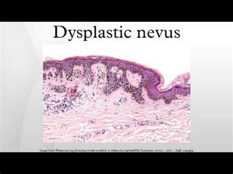 Dysplastic nevus - YouTube