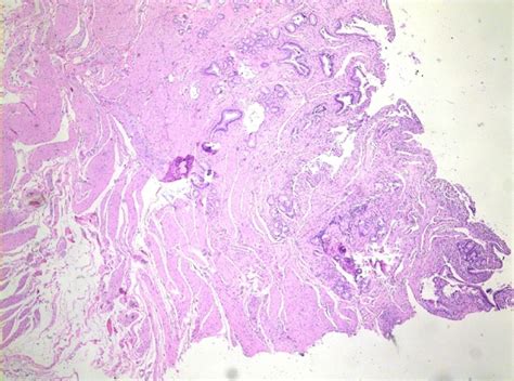 Adenomyoma of the distal common bile duct demonstrated by endoscopic ultrasound: A case report ...