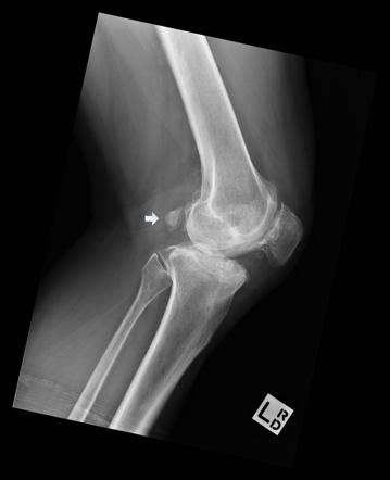 Fabella | Radiology Reference Article | Radiopaedia.org