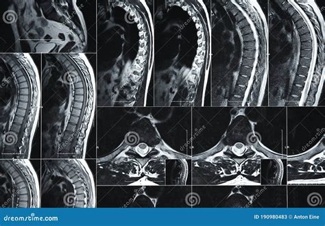 MRI Or CT Scan Of Human Lumbar Spine Royalty-Free Stock Photo | CartoonDealer.com #190980483