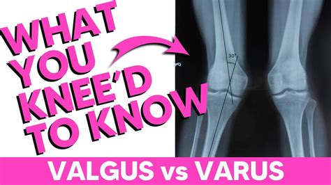 Valgus vs Varus (The Best Mnemonic) - YouTube