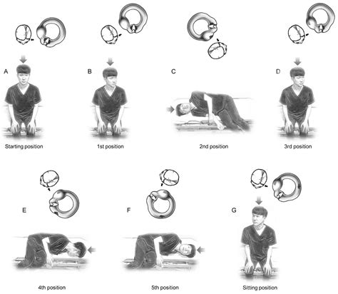 JCM | Free Full-Text | New Therapeutic Maneuver for Horizontal ...