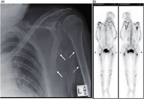 (a) X-ray image showing heterotopic calcification along the medial ...