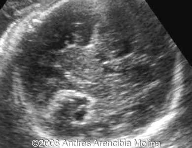 📃 Congenital hypothalamic hamartoma syndrome