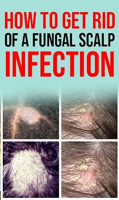 How To Get Rid Of A Fungal Scalp Infection Causes, Symptoms, And Natural Remedies - Healthy ...