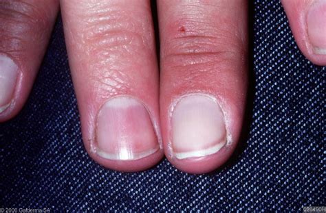 This Is What Those White Marks On Your Fingernails Really Mean | Image nails, Nail health, White ...