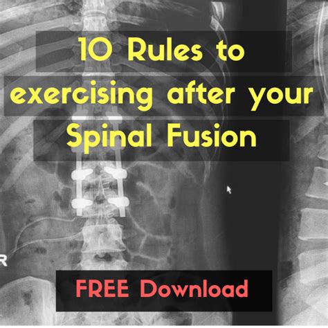 Pin on Lumbar fusion