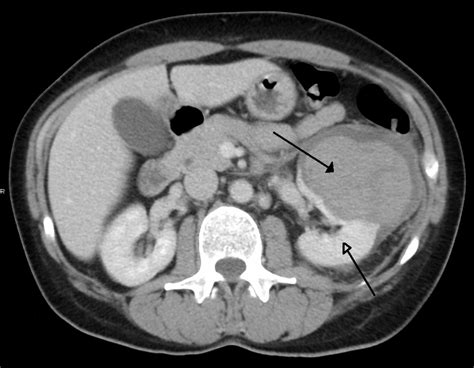 Retroperitoneal Space | Images and Photos finder