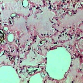 Photomicrograph showing lanugo hair and amniotic fluid debris. (H-E;... | Download Scientific ...