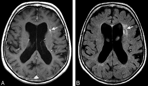 Parenchyma Brain