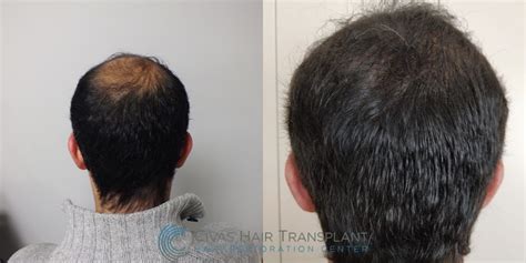 Civas Hair Transplant- FUE Hair Transplant Before & After Pictures (3200 Grafts) | Hair loss ...