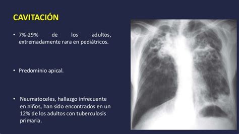 Tuberculosis pulmonar en la radiografía de tórax