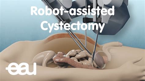 Robot-Assisted Cystectomy - YouTube