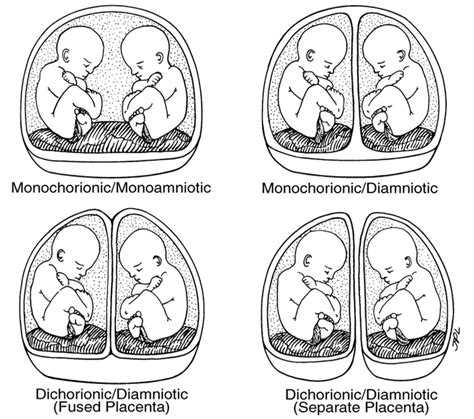 Multiple pregnancy :: Healthier Together