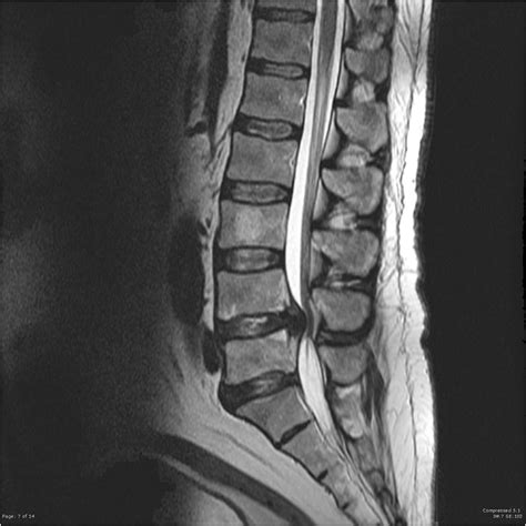 Cauda Equina Syndrome – Core EM