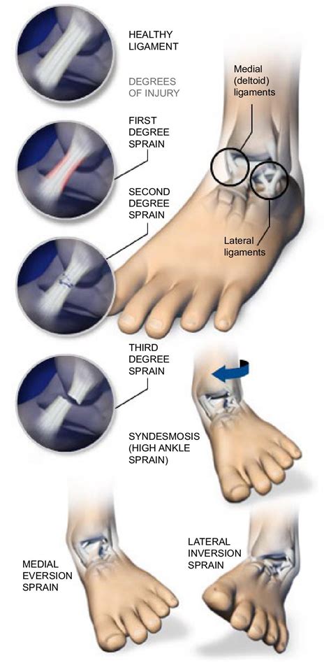 Lateral Ankle Sprain Mechanism Of Injury