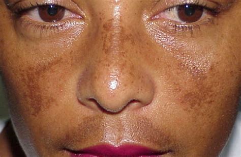 Best Skin Lightening To Eliminate Hyperpigmentation or Melasma: How to Treat Melasma