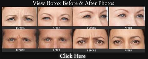 Botox Aftercare and Post Botox Instructions - My Botox LA Med Spa News & Articles