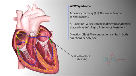 Wolff Parkinson White Wpw Syndrome