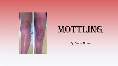 Mottling