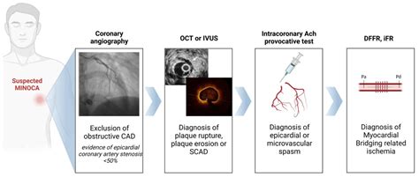 JCM | Free Full-Text | MINOCA Associated with a Myocardial Bridge ...