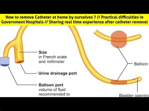 How to remove Catheter at home by ourselves ? // Sharing real time experience after catheter ...