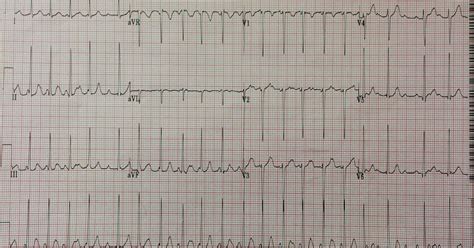 Dr. Smith's ECG Blog: Irregularly irregular supraventricular very fast rhythm: what is it?