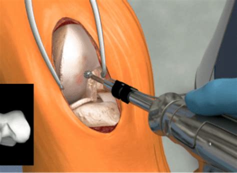 Learn about robotic-arm assisted knee surgery | Stryker