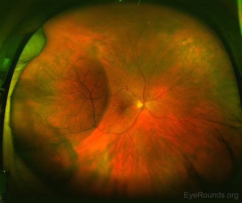 Acquired Peripheral Retinoschisis