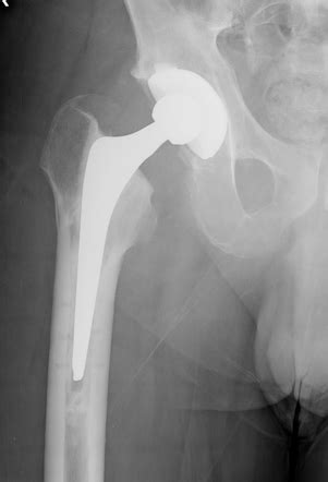 Total hip arthroplasty | Image | Radiopaedia.org