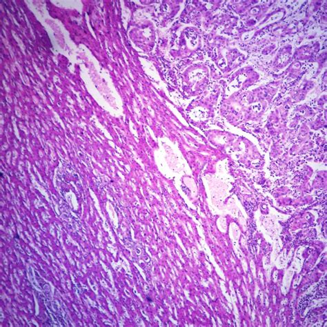 Human Metastatic Carcinoma to Liver, sec. 7 µm H&E Microscope Slide | Carolina Biological Supply