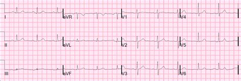 Dr. Smith's ECG Blog: Unstable angina still exists. Beware.