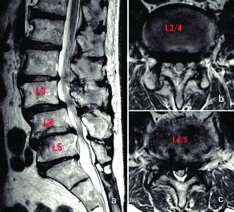 Symptoms Of Severe Spinal Stenosis Of L4-L5 Premia Spine, 59% OFF